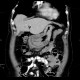 Gastritis, acute, antral: CT - Computed tomography